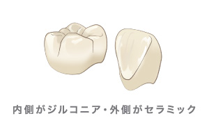 内側がジルコニア・外側がセラミック