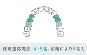 保険適応範囲：4・5番、診断により6番も