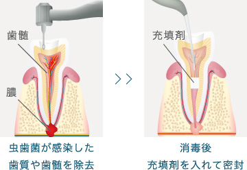 虫歯菌が感染した歯質や歯髄を除去→消毒後、充填剤を入れて密封