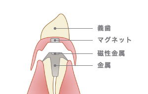 義歯・マグネット・磁性金属・金属