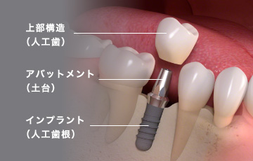 上部構造（人工歯）アバットメント（土台）インプラント（人工歯根）