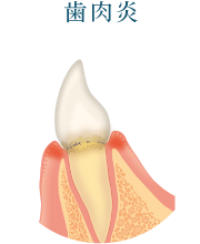 歯肉炎