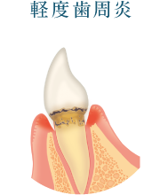 軽度歯周炎