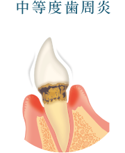 中等度歯周炎